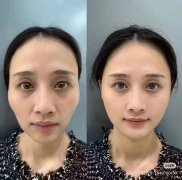 北京试药 医美项目报名颞部凹陷（太阳穴填充） 2000元 ！！试药员招聘 试药报